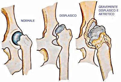 displasia